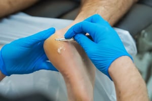 Podiatry - Calluses - Removal