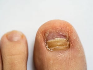 Fungal Nail