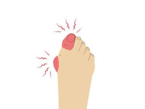 Juvenile Bunions