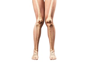 Knock Knee