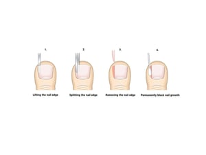Partial nail avulsion image