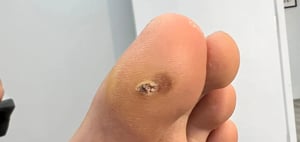 Plantar Warts