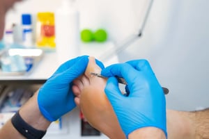 Podiatry - Corn & Calluses - Treatment