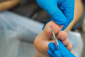Podiatry Corn Calluses 2