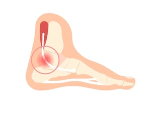 Posterior Tibial Tendon Dysfunction