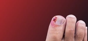 The Best Option for Ingrown Toenail Treatment GP or Podiatry - Blog banner image (1)