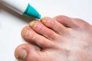 Toe Nail Infection Fungal