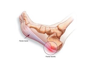 podiatry plantar fasciitis